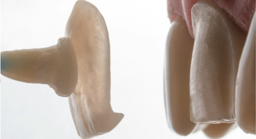 Zahnkronen und Veneers (CEREC) - Dr. Sarah Abdel-Hamied - Zahnärztin Wien 1050