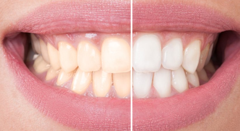 Bleaching - Dr. Claudia Kloodt, MSc. - Zahnärztin Wien 1090