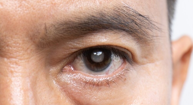 Katarakt (Grauer Star) - Linsenimplantation - Dr. Clemens Bernhart - Augenarzt Wien 1010