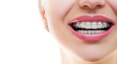 Kieferorthopädie (festsitzende, abnehmbare und unsichtbare Zahnspange)