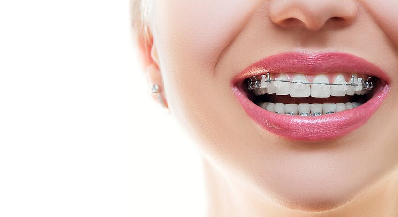 Kieferorthopädie (festsitzende, abnehmbare und unsichtbare Zahnspange) - Dr. Amadeus Gottsauner - Zahnarzt Wien 1090