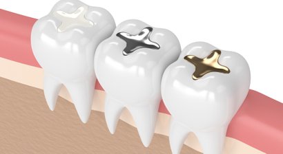 Füllungstherapie / Ästhetische Füllungen