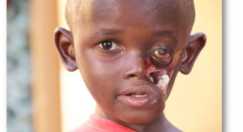 NOMA – Wiederherstellung von Kindergesichtern in Westafrika - Dr. Harald Kubiena - Plastischer Chirurg Wien 1190