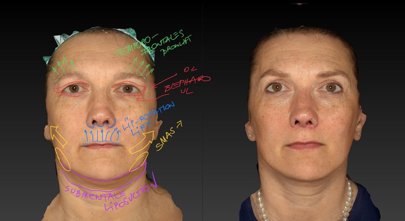 Ästhetische Gesichtschirurgie - Dr. Harald Kubiena - Plastischer Chirurg Wien 1190