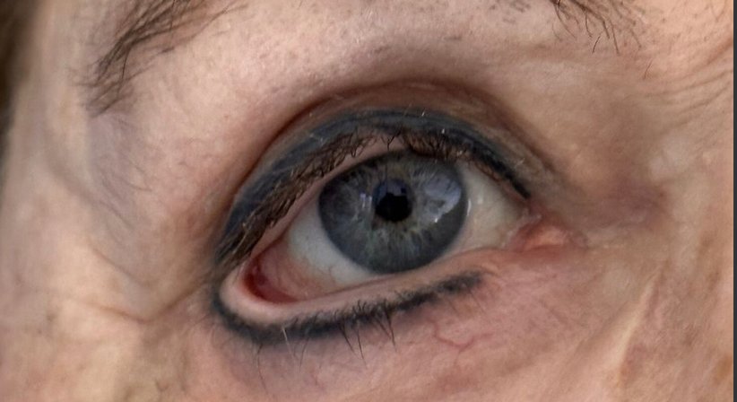 Narben, Weichteilveränderungen & Asymmetrien des Gesichts - Dr. Harald Kubiena - Plastischer Chirurg Wien 1190