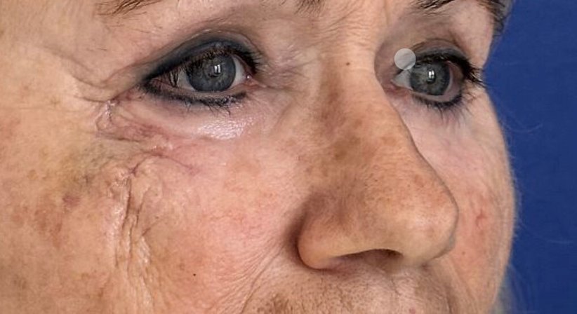 Narben, Weichteilveränderungen & Asymmetrien des Gesichts - Dr. Harald Kubiena - Plastischer Chirurg Wien 1190