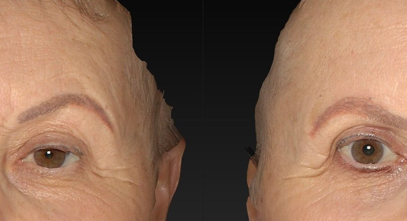 Narben, Weichteilveränderungen & Asymmetrien des Gesichts - Dr. Harald Kubiena - Plastischer Chirurg Wien 1190