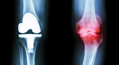 Knieprothese (Künstliches Kniegelenk) / Gonarthrose