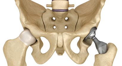 Hüft-Totalendoprothese (Hüft-TEP, Künstliches Hüftgelenk)