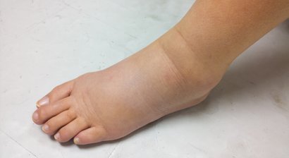 Knochenmarködem – Abklärung und Therapie