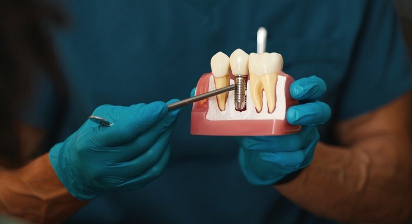 Implantologie bei Dr. Jacob Polzer