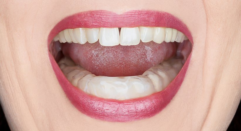 Knirscherschienen - DDr. Silvia Laudenbach - Zahnärztin Wien 1150