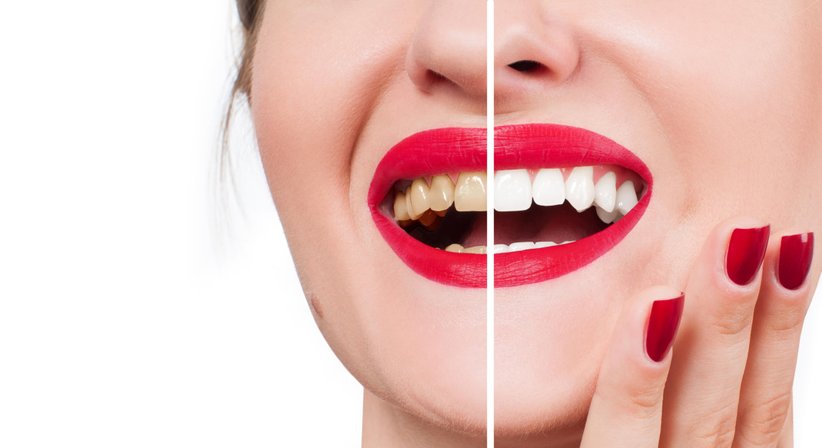 Bleaching - DDr. Silvia Laudenbach - Zahnärztin Wien 1150