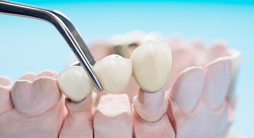 Brückenversorgung - DDr. Silvia Laudenbach - Zahnärztin Wien 1150