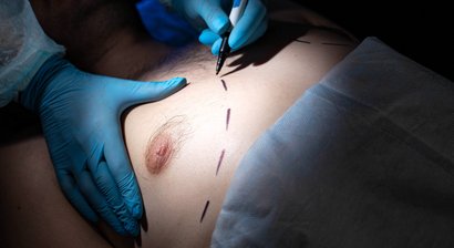 Gynäkomastie OP (Brustkorrektur beim Mann)