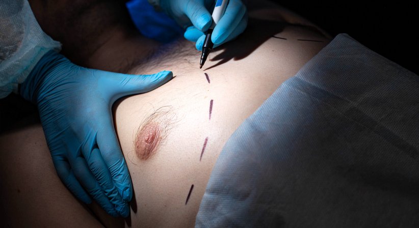 Gynäkomastie OP (Brustkorrektur beim Mann) - Dr. med. univ. Alexander Nimmerfall - Plastischer Chirurg Wels 4600