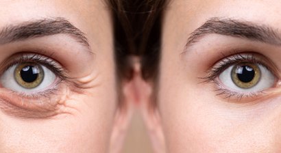 Ober-und Unterlidstraffung ( Blepharoplastik)