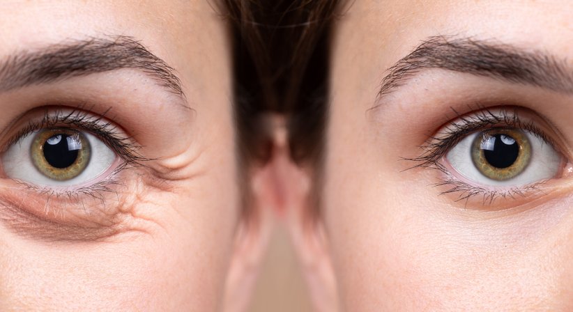 Ober-und Unterlidstraffung ( Blepharoplastik) - Dr. med. univ. Alexander Nimmerfall - Plastischer Chirurg Wels 4600