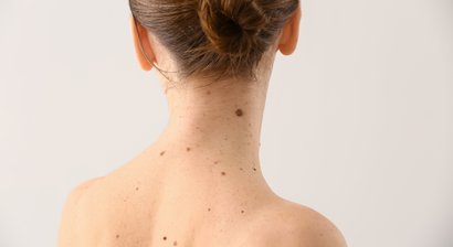  Entfernung von Hautveränderungen (u.a. Muttermal, Basaliom etc.)