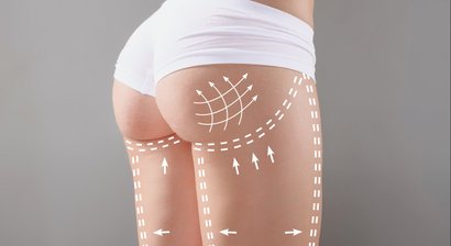 Lipofilling (Eigenfettunterspritzung)