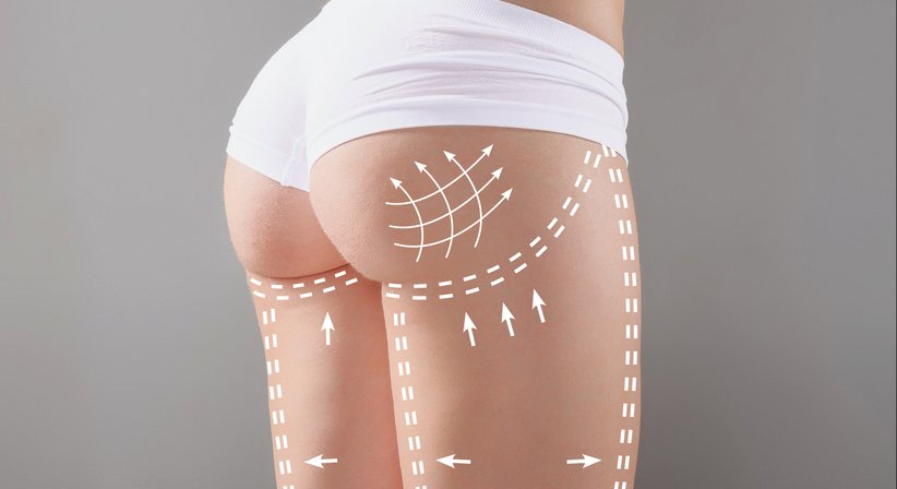 Lipofilling (Eigenfettunterspritzung) - Dr. med. univ. Alexander Nimmerfall - Plastischer Chirurg Wels 4600