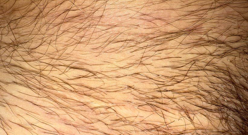 Narbenentstörung  - Dr. Paul Fink - Praktischer Arzt Neuhaus am Klausenbach  8385