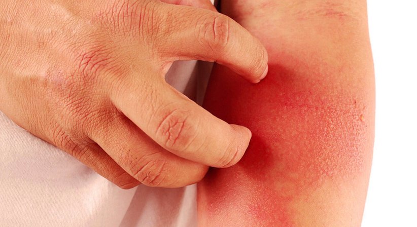 Behandlung von Hauterkrankungen - Dr.med. Tatyana Hübscher - Hautärztin Wien 1010