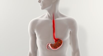 pH-Metrie zur Abklärung von Refluxbeschwerden