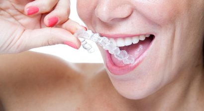 Aligner Therapie – durchsichtige Schienen