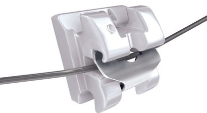 außenliegende Zahnregulierung mit Clear Brackets