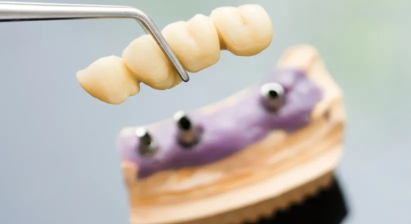 Implantate / Knochenaufbau - Dr. med. dent. Viktor Angelov, MSc. - Zahnarzt Wien 1020