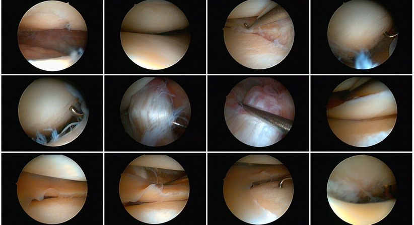 Arthroskopie (Gelenkspiegelung) Schulter, Knie - OA Dr. Thomas Kolp - Orthopäde Korneuburg 2100