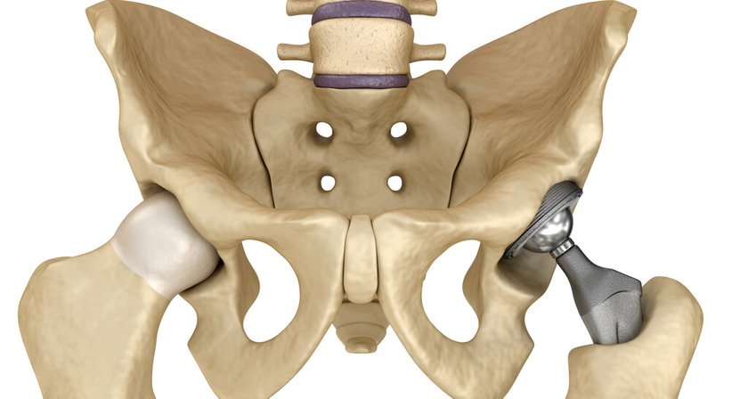 Hüfttotalendoprothese (Hüft-TEP) - OA Dr. Thomas Kolp - Orthopäde Korneuburg 2100