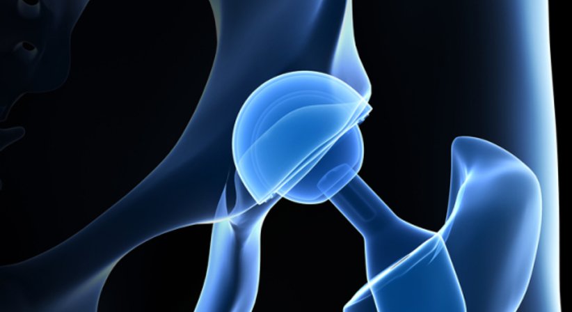 Hüftschmerzen - OA Dr. Ralph Schmid - Orthopäde Eisenstadt 7000