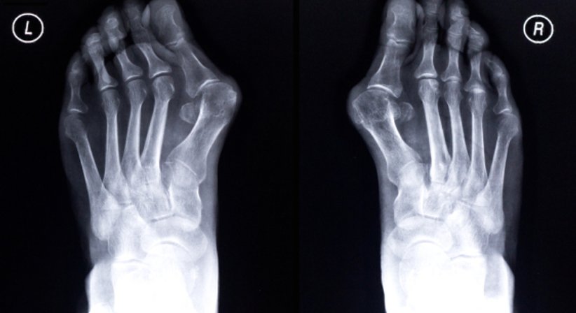 Fußschmerzen - OA Dr. Ralph Schmid - Orthopäde Wiener Neustadt 2700