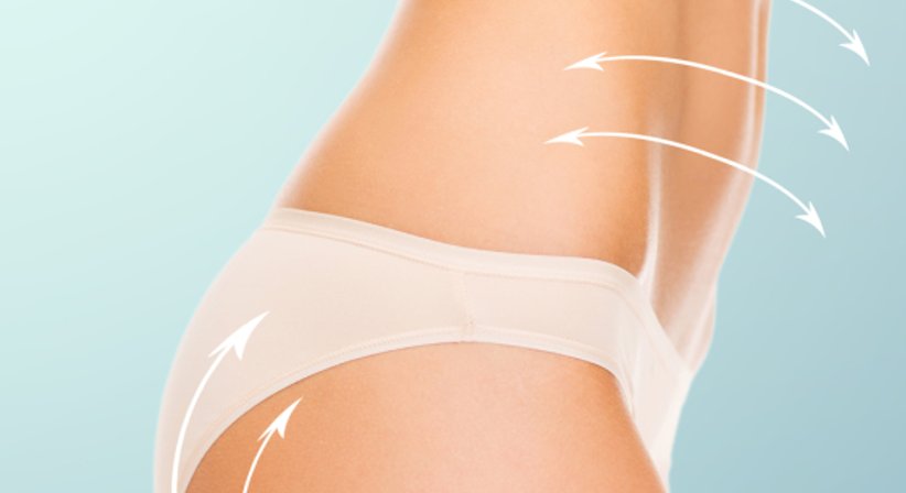 Fettabsaugung - OA Dr. Rene Kaplan - Plastischer Chirurg Mondsee 5310