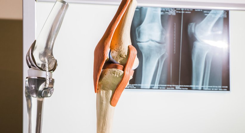 Künstliches Kniegelenk - Dr. Christian Lhotka - Orthopäde Wien 1010