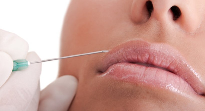 Hyluronsäure Fillerbehandlung Volumenaufbau - Dr. Bettina Wiltos - Allgemeinchirurgin Mödling 2340