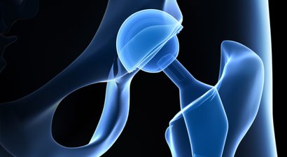 Hüfttotalendoprothese