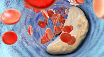 Koronare Herzkrankheit (KHK) – Abklärung und Therapie