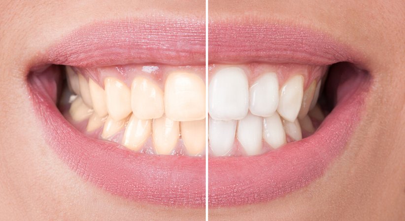 Bleaching - Dr. Valentin Kunz - Zahnarzt Wien 1080