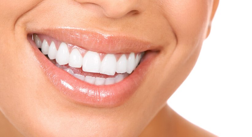 Unsichtbare Zahnspange/ Aligner nach der Invisalign-Methode - Dr. Valentin Kunz - Zahnarzt Wien 1080