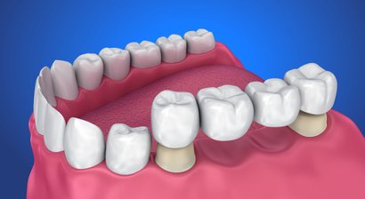Zahnkronen und Zahnbrücken