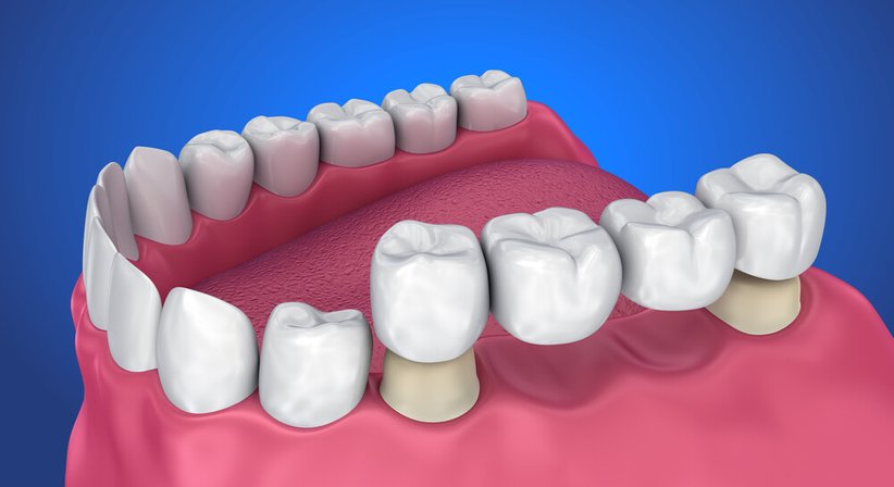 Zahnkronen und Zahnbrücken - Dr. Valentin Kunz - Zahnarzt Wien 1080