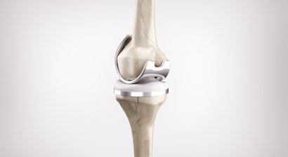 3D gestützter Kniegelenkersatz (MyKnee®) / Knieendoprothetik