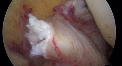 Kreuzbandriss / Bandrekonstruktion / Kreuzbandplastik