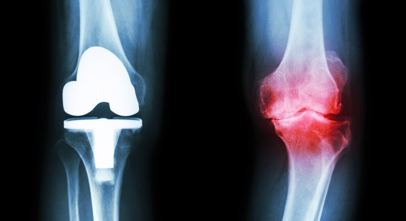 Gonarthrose (Kniearthrose) - OA Dr. Georg Brandl - Orthopäde Wien 1130