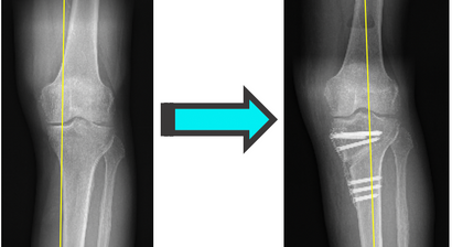 Beinachsenkorrektur / Umstellungsosteotomie