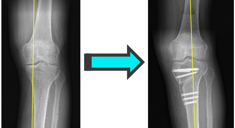 Beinachsenkorrektur / Umstellungsosteotomie - OA Dr. Georg Brandl - Orthopäde Wien 1130