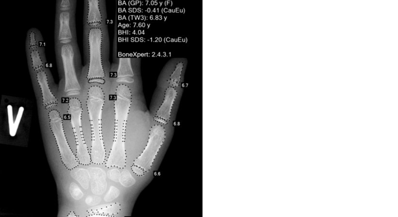 Bestimmung der Endgröße - Dr. Axel Gebauer - Radiologe Baden 2500
